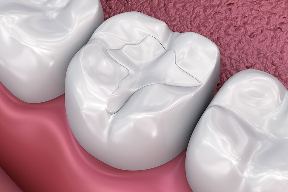 Dental Fillings